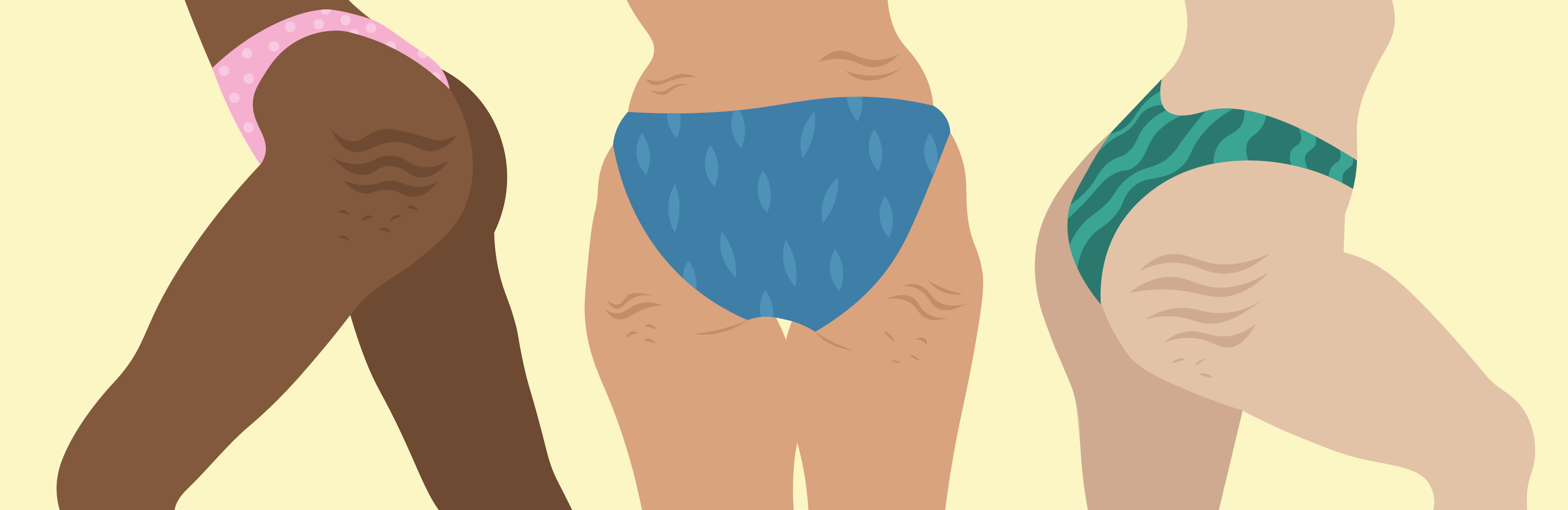 Putjes in je billen en benen? Zó ontstaat cellulite